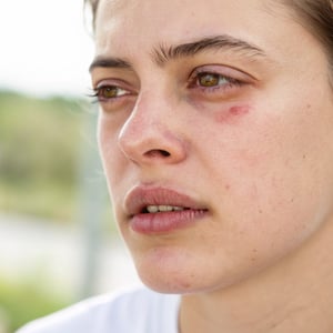 What You Need to Know About Angioedema in 2025